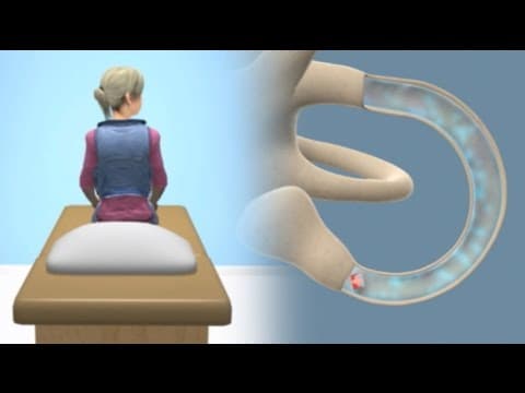 Ménière's Disease & Endolymphatic Hydrops: Vertigo Explained